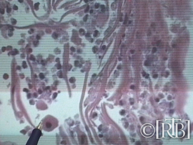 table Forensic Pathologist Dr. Robert Lawrence in San Francisco who identified it as epidermis (skin) infiltrated with white blood cells.