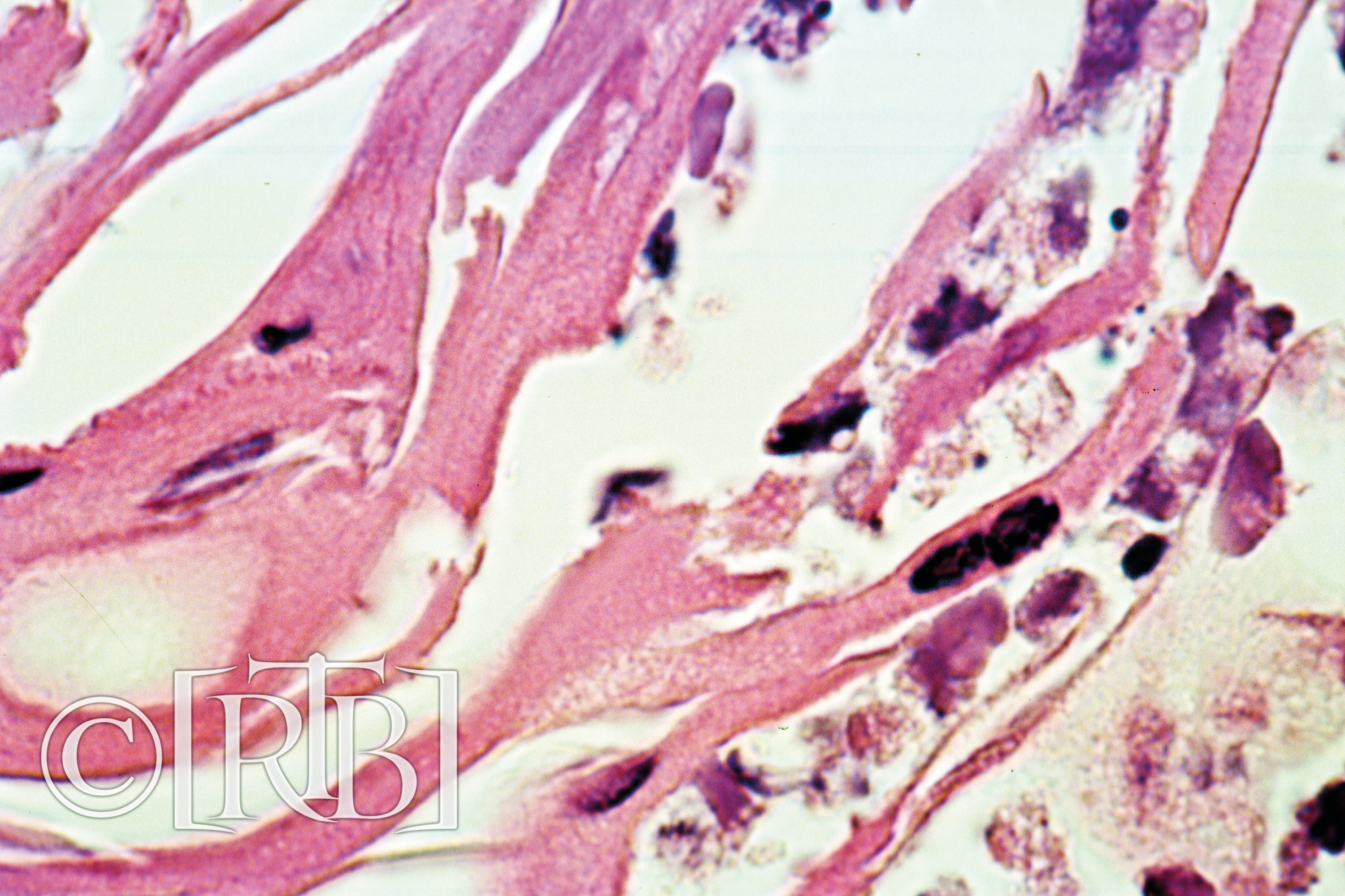 Microscopic histological slide showing inflamed human myocardium tissue (heart muscle) with active white blood cells