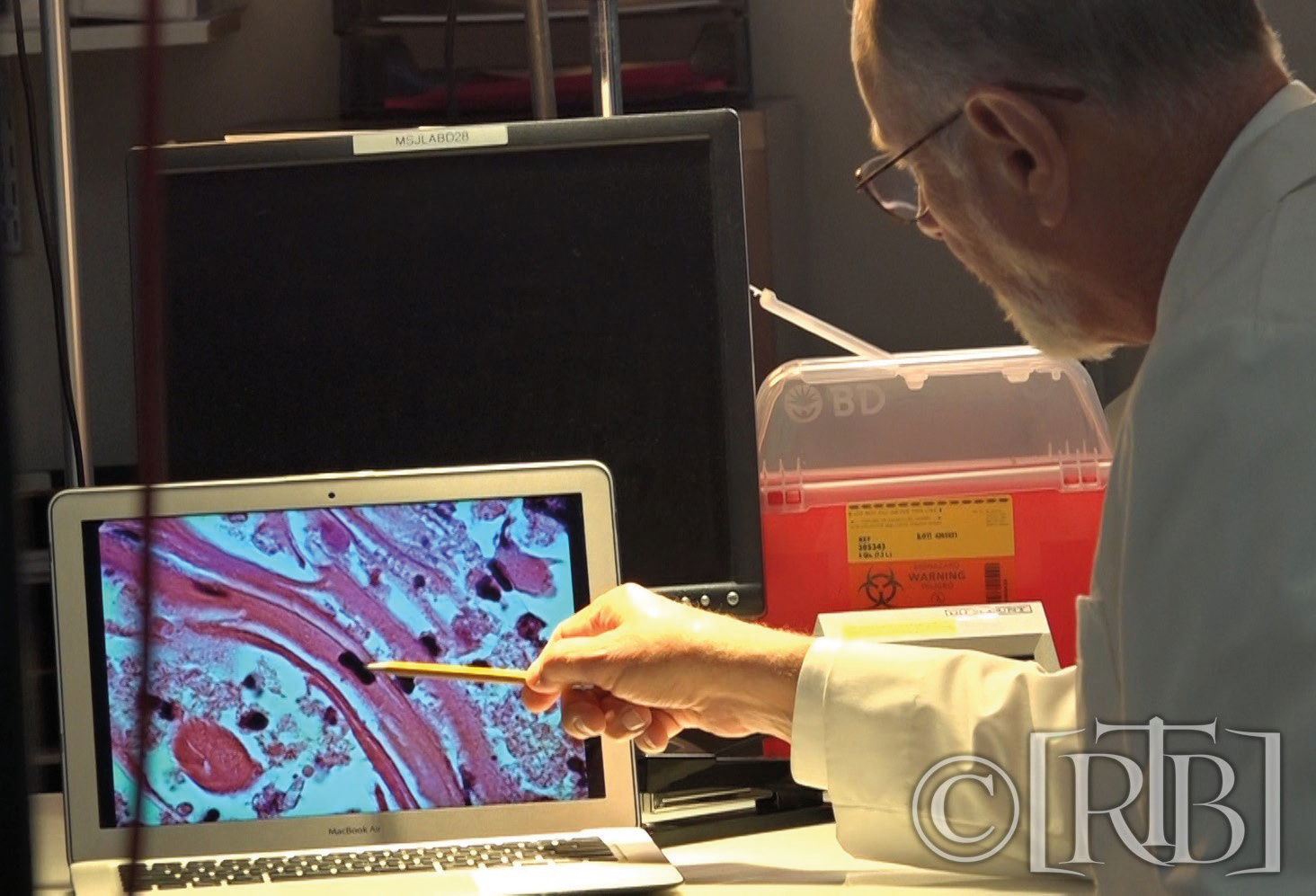Forensic Pathologist Dr. Robert Lawrence of San Francisco who confirmed the histological findings