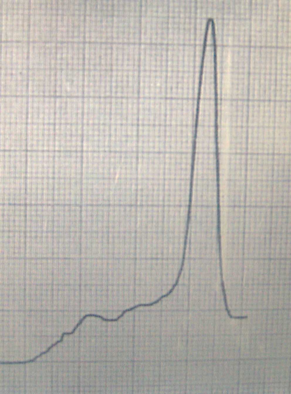 Graph of the electrophoresis of the proteins of the Blood of the Miracle. The profile of the protein fractions from the serum could be superimposed on a standard specimen of fresh blood