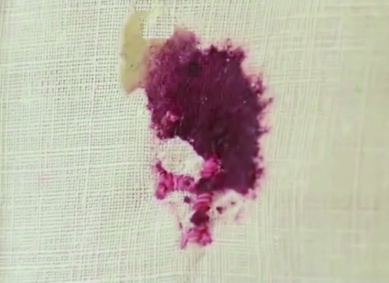 The two scientists have affirmed that it is not possible that someone had placed a fragment of a human body in the tabernacle since the fragments that made up the Host were tightly interconnected to the fibers of the human tissue, and penetrated each other, as if a frag-